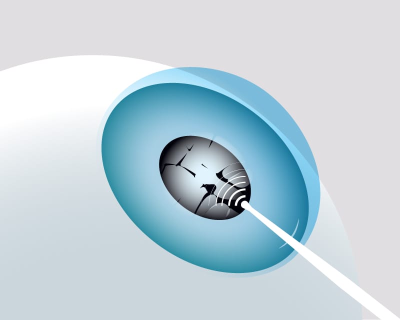 Ultrasonic probe to divide cataract into small pieces
