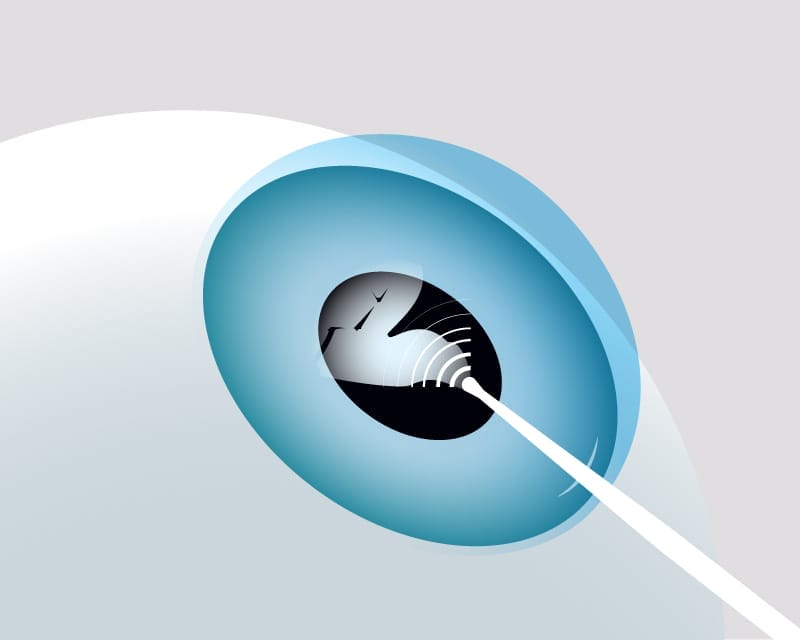 Cataract is suctioned out with ultrasonic energy