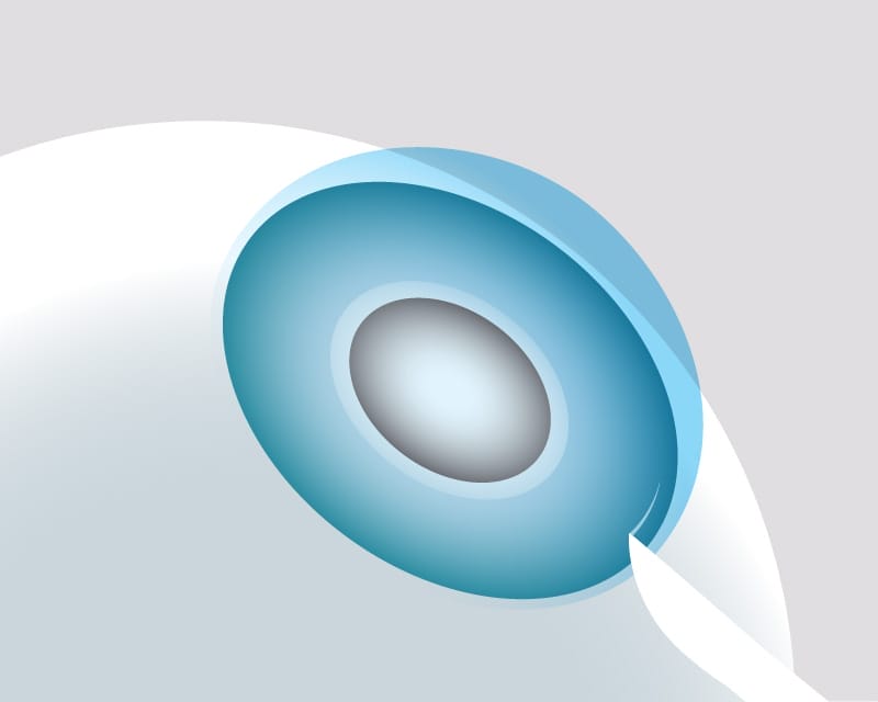 Make small incision into cornea