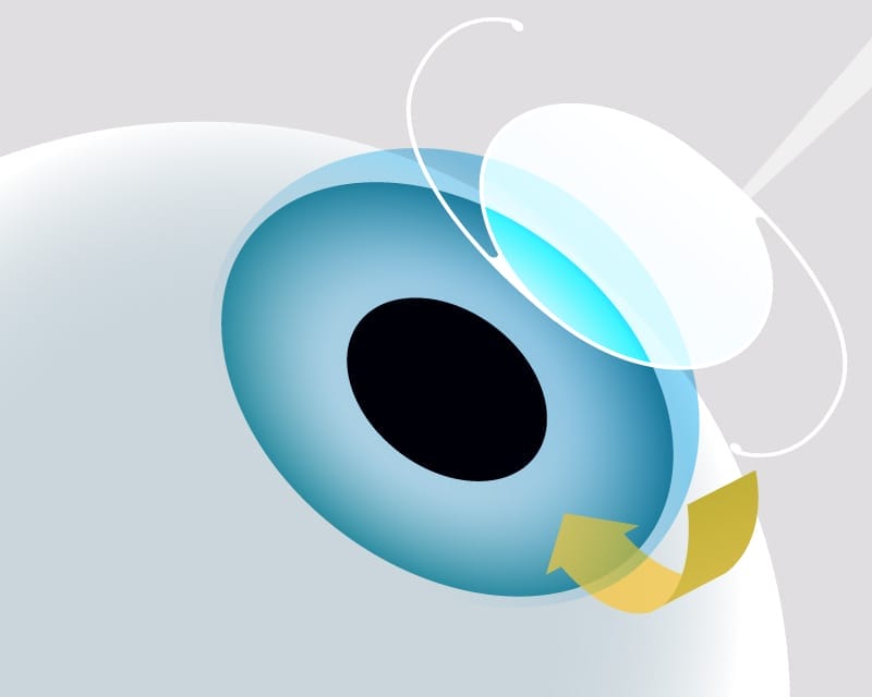 Artificial lens is implanted