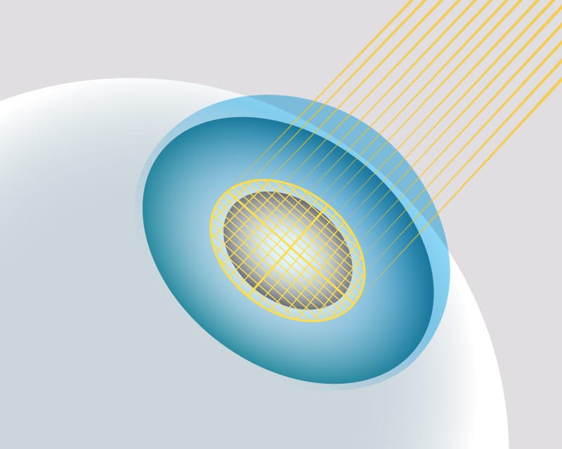 The femtosecond laser creates openings, breaks the lens into small pieces, and corrects any astigmatism