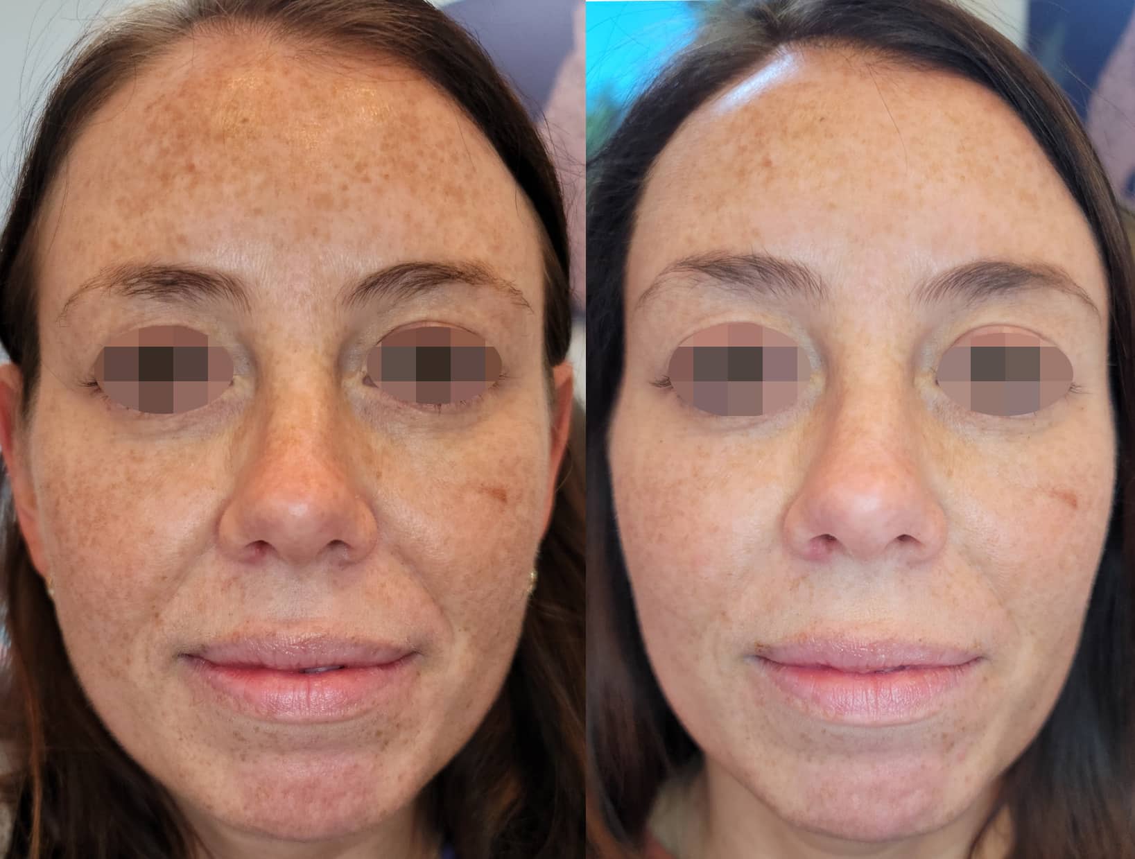 CO2 Laser Skin Resurfacing – Prity Skincare